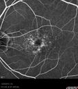 maculardystrophy_kewa_12201223.jpg