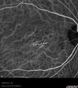 maculardystrophy_kewa_12201227.jpg