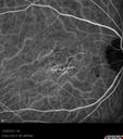 maculardystrophy_kewa_12201228.jpg