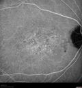 maculardystrophy_kewa_12201230.jpg