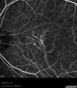 maculardystrophy_kewa_12201231.jpg