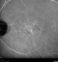 maculardystrophy_kewa_12201234.jpg