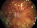 macularlaser-dm-leer_28229.png