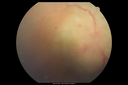 maretinitis_uveitis_pefo1_12031201.png