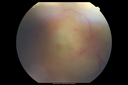 maretinitis_uveitis_pefo1_12031202.png