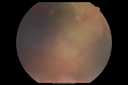 maretinitis_uveitis_pefo1_12031205.png