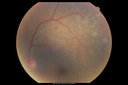 maretinitis_uveitis_pefo1_12031207.png