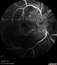 maretinitis_uveitis_pefo1_12031214.jpg