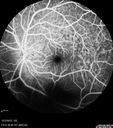 maretinitis_uveitis_pefo1_12031218.jpg