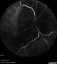 maretinitis_uveitis_pefo1_12031222.jpg
