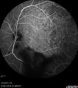 maretinitis_uveitis_pefo1_12031229.jpg