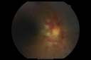 maretinitis_uveitis_pefo2_02061332.png