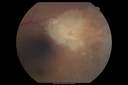 maretinitis_uveitis_pefo2_02061334.png