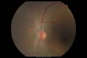 maretinitis_uveitis_pefo2_02061337.png