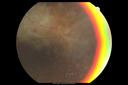 maretinitis_uveitis_pefo2_02061338.png