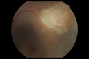 maretinitis_uveitis_pefo2_02061340.png