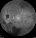 maretinitis_uveitis_pefo2_02061344.jpg