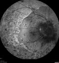 maretinitis_uveitis_pefo2_02061346.jpg