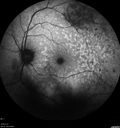 maretinitis_uveitis_pefo2_02061347.jpg