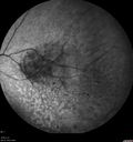 maretinitis_uveitis_pefo2_02061348.jpg