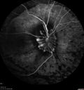 maretinitis_uveitis_pefo2_02061354.jpg