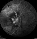 maretinitis_uveitis_pefo2_02061356.jpg