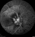 maretinitis_uveitis_pefo2_02061357.jpg