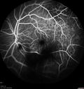 maretinitis_uveitis_pefo2_02061359.jpg