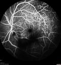 maretinitis_uveitis_pefo2_02061360.jpg