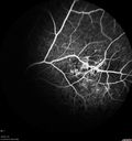maretinitis_uveitis_pefo2_02061361.jpg