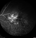maretinitis_uveitis_pefo2_02061365.jpg