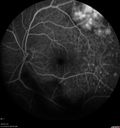 maretinitis_uveitis_pefo2_02061366.jpg
