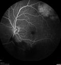 maretinitis_uveitis_pefo2_02061368.jpg