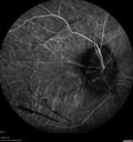 maretinitis_uveitis_pefo2_02061371.jpg