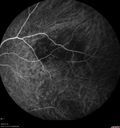 maretinitis_uveitis_pefo2_02061374.jpg