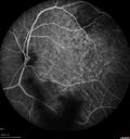 maretinitis_uveitis_pefo2_02061375.jpg