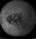 maretinitis_uveitis_pefo2_02061378.jpg