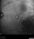 mediummelanoma_brfu_10.jpg