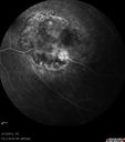mediummelanoma_brfu_17.jpg