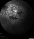 mediummelanoma_brfu_19.jpg