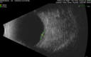 melanoma-mac_jamoc_050719__01.png