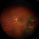 melanoma_105753_12721_02.jpg