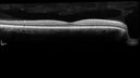 melanoma_105753_12721_07.jpg