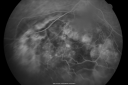 melanomaexudativerd_wikr09.png