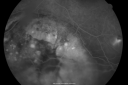 melanomaexudativerd_wikr11.png