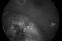 melanomaexudativerd_wikr12.png