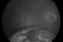 melanomaexudativerd_wikr14.png