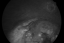 melanomaexudativerd_wikr15.png