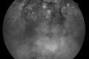 melanomaexudativerd_wikr18.png