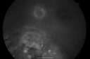melanomaexudativerd_wikr20.png
